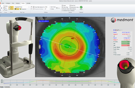 corneal topography using a medmont topographer for an orthoK assessment