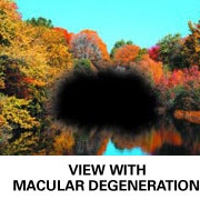 Stem cells help regain sight for patients with macula degeneration 1 how macula degeneraton affects your central vision