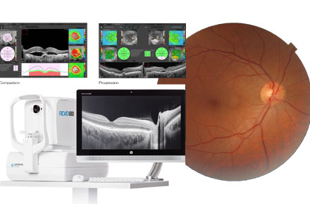 Technology OCT scan and and image of the retina